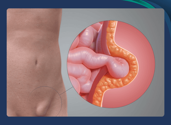 Can Hernia and Gallbladder Stone Surgery Be Done Simultaneously? | Expert Guide