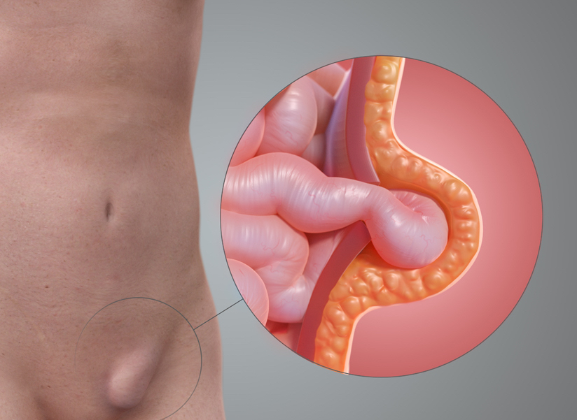 Hiatal Hernia in Young Adults: Causes, Symptoms, Treatment & Prevention