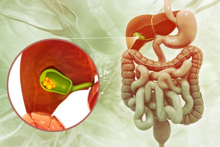 Gall Bladder Stones Slipping in the Cystic Duct: Causes, Symptoms & Treatment