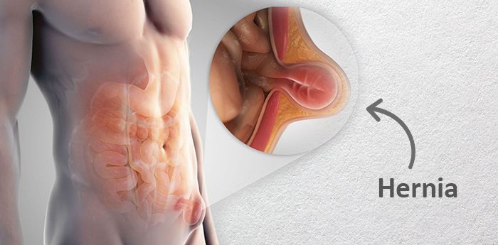 Complex Hernias: Causes, Symptoms & Advanced Treatment Options