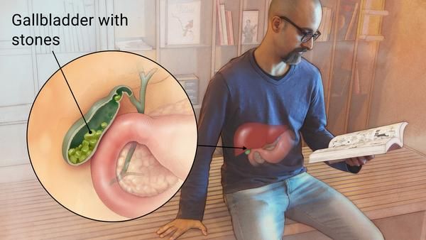 Can Gallbladder Stones Be Dangerous? Symptoms, Risks & Treatment
