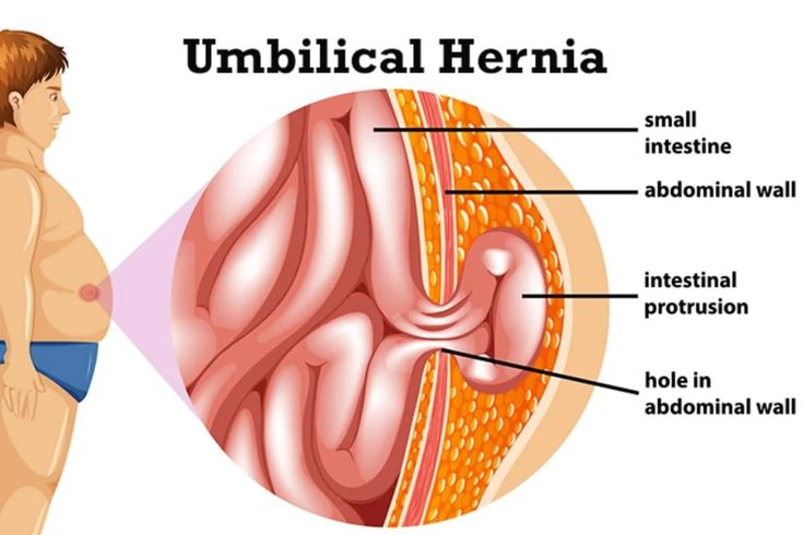 Umbilical Hernia: Causes, Symptoms, Treatment