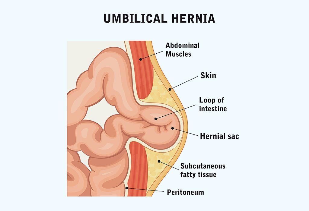 Umbilical Hernia & Gallstones: What to Do