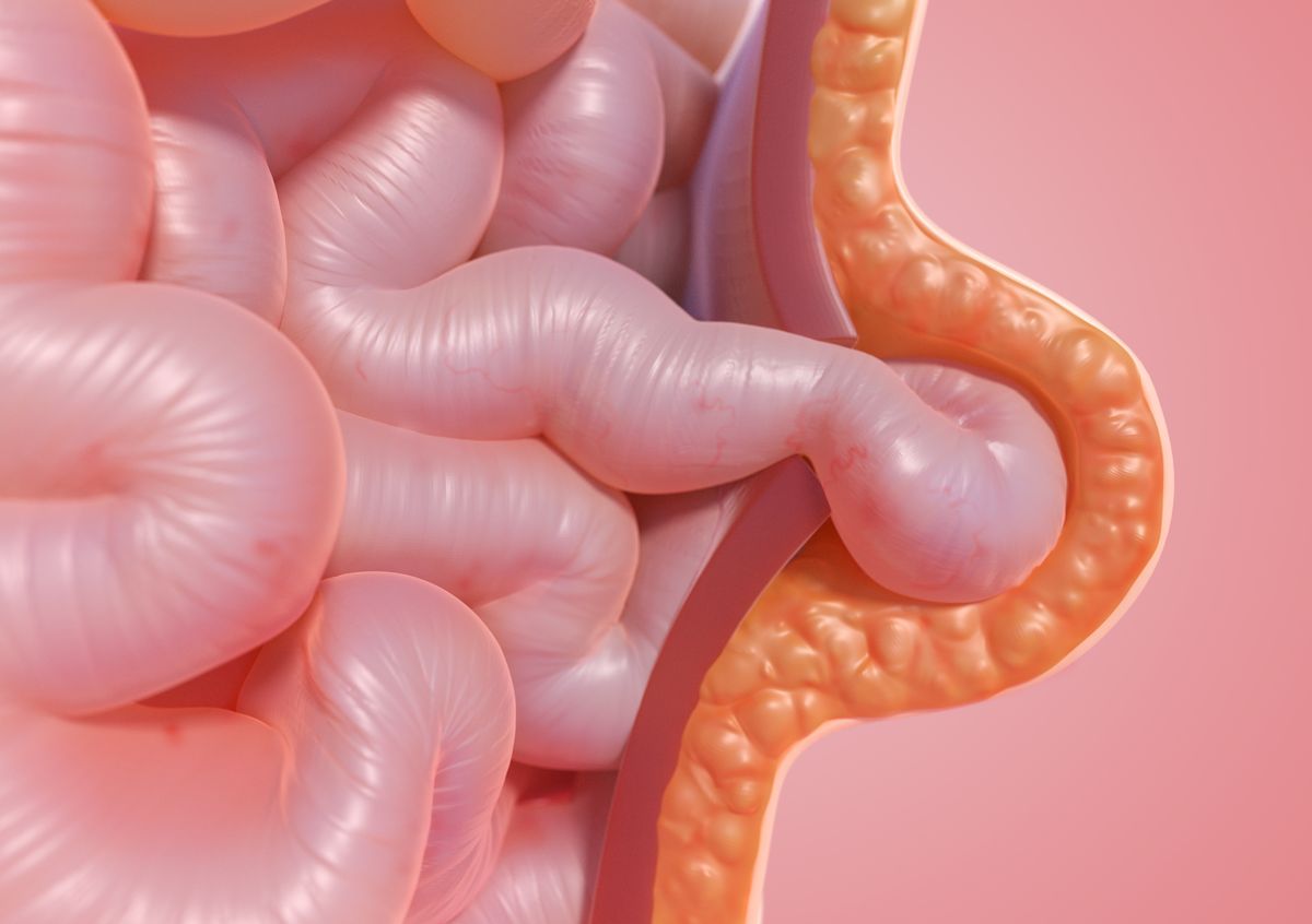 What is Complex or Complicated Hernia? Causes & Treatment