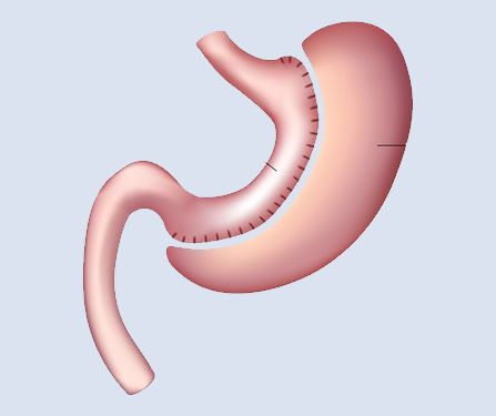 Sleeve Gastrectomy: Effective Bariatric Surgery for Weight Loss