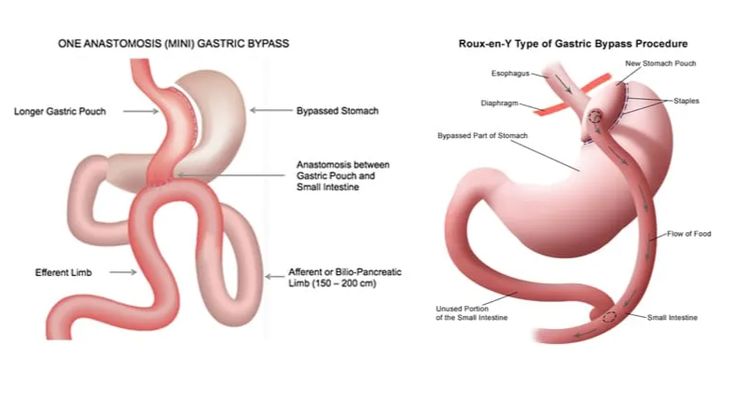 Best Bariatric Surgeon in Delhi NCR: Expert Weight Loss Care