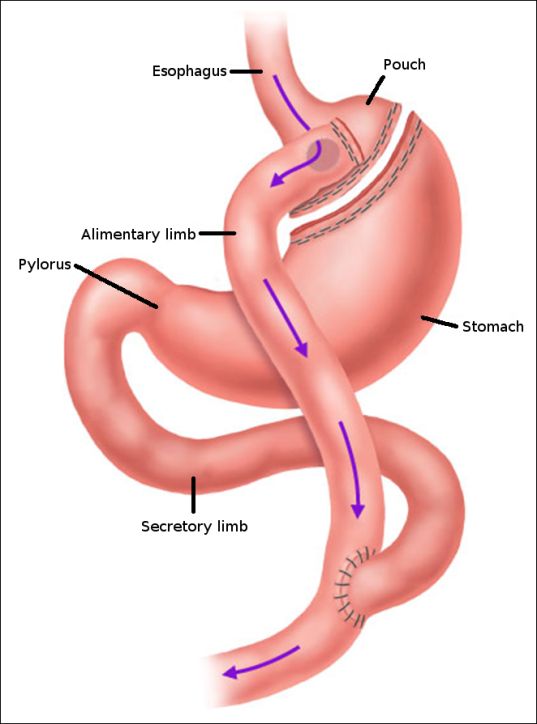 Gastric Bypass vs Sleeve Gastrectomy in India: Which Weight Loss Surgery is Right for You?