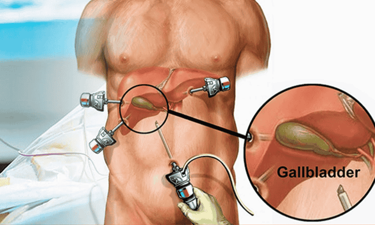 gallbladder-surgery
