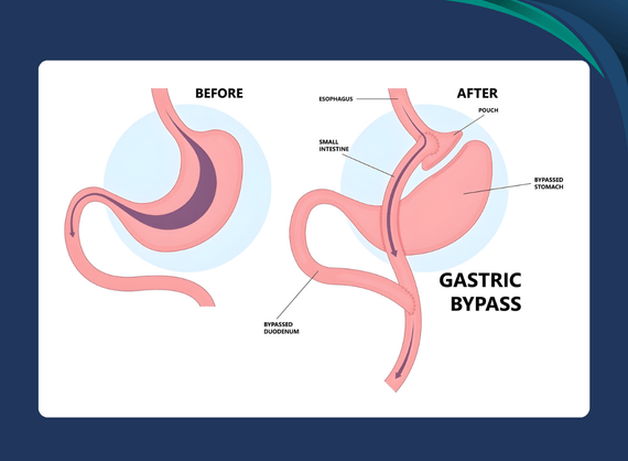 Gastro Esophageal Surgery