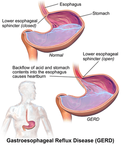 esophageal sphincter